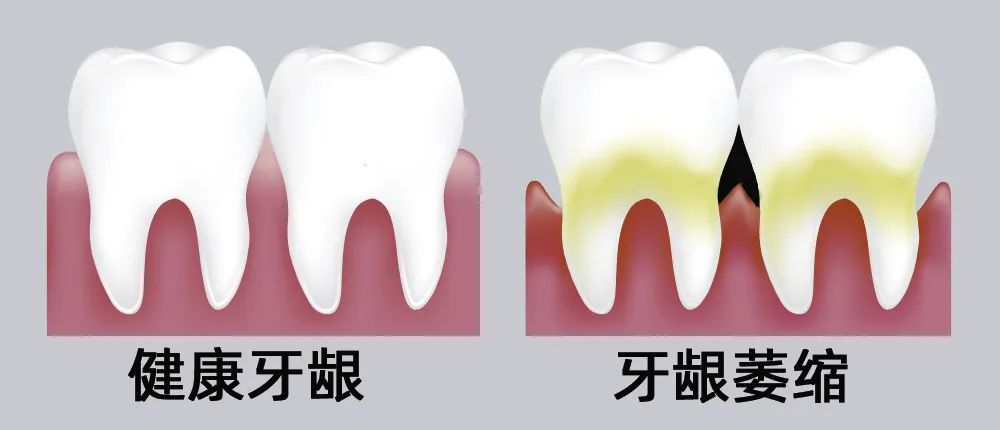 牙縫大露出“黑三角”，既塞牙又難看！還能恢復(fù)嗎？