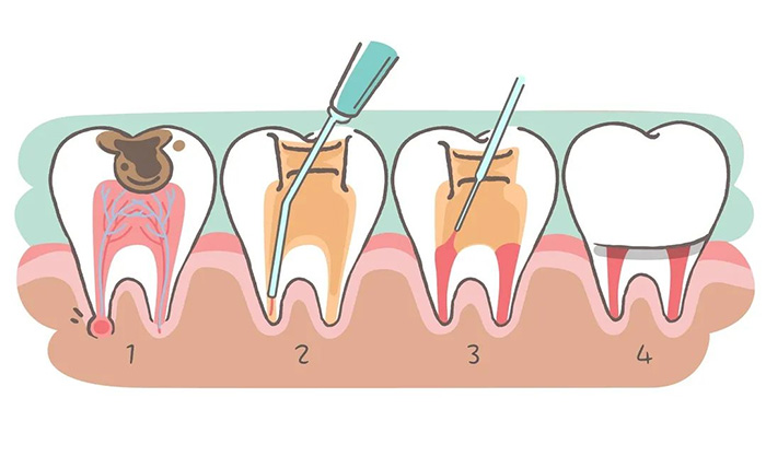 細(xì)說(shuō)根管治療，聽(tīng)聽(tīng)專(zhuān)家怎么講...